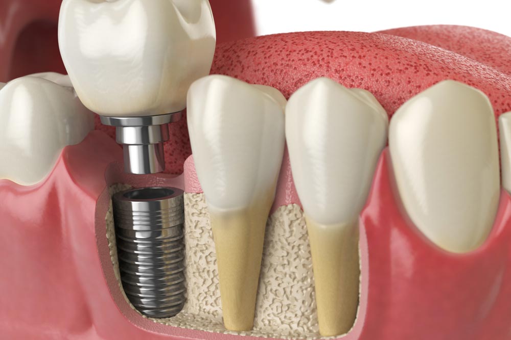 tooth dental implant in human dentura