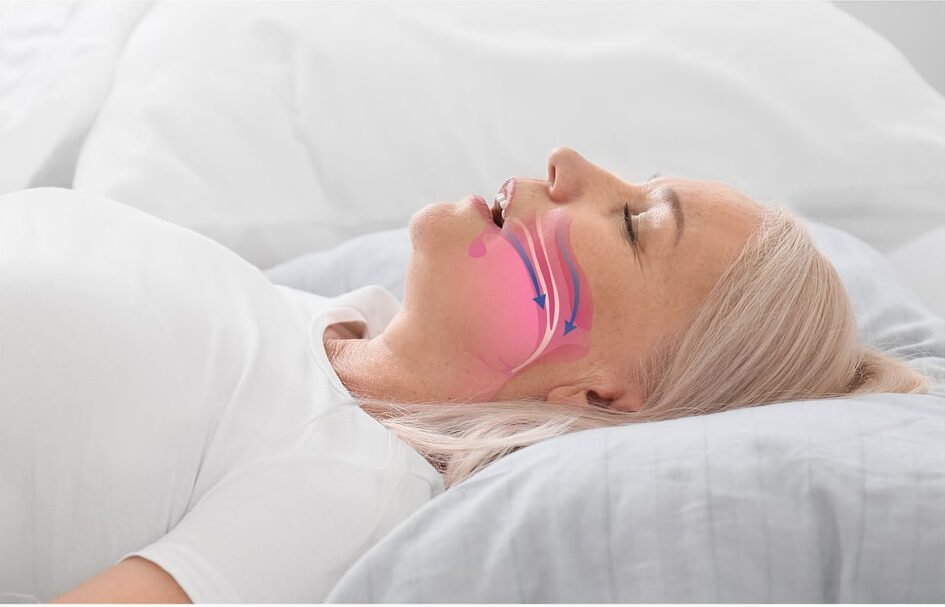 Illustration showing airway during obstructive sleep apnea