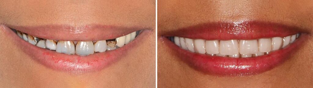 Before and after dental Treatment